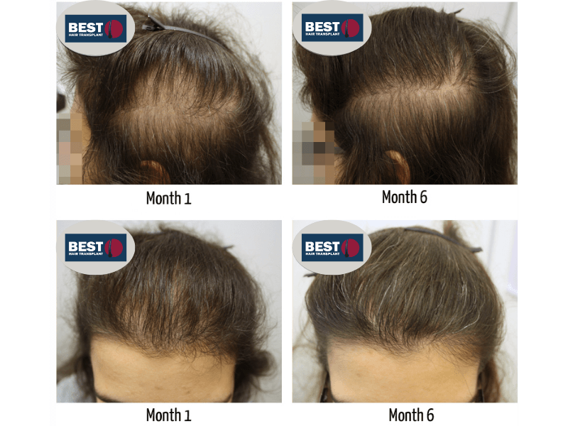 Treatment for Diffuse Hair Loss