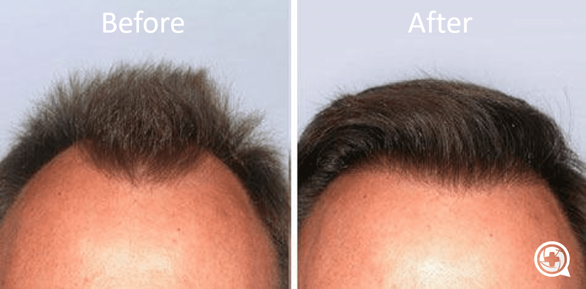 Photo of Detailed Article To Know About Textured Hair Transplant