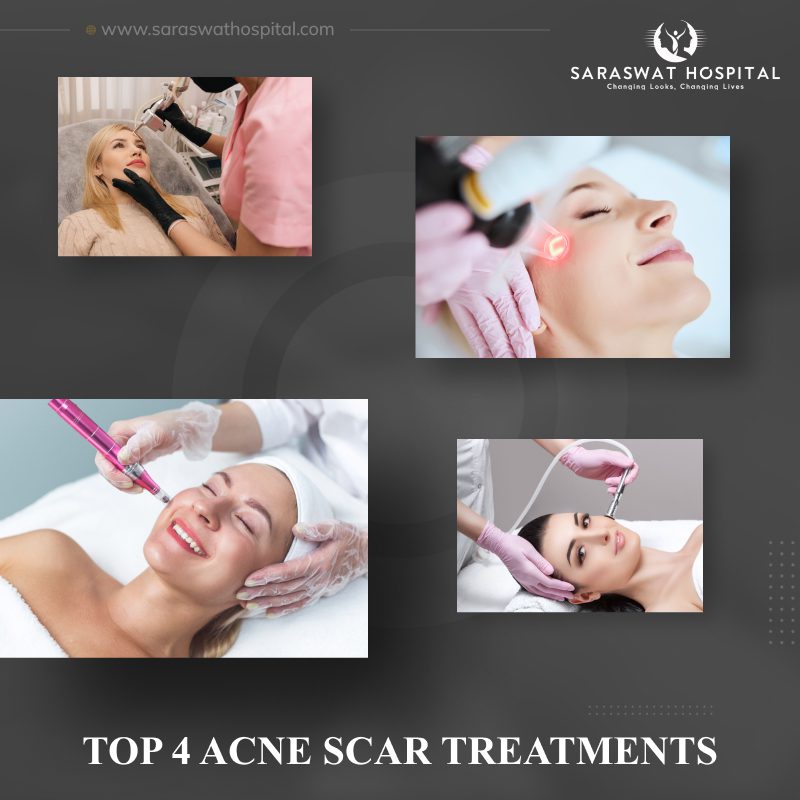 acne scar treatment