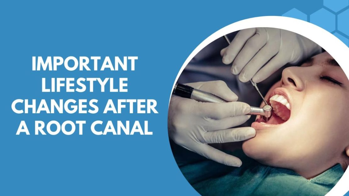 Photo of Important Lifestyle Changes after a Root Canal